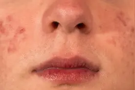 不同部位长痘痘，代表不同内脏有问题？从中医的角度这么看图片