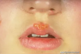 嘴上长“泡”仅仅是因为上火？医生说这“泡”不只是长在嘴边图片