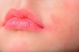 什么是敏感肌肤？该如何修复？图片