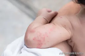 不小心患上荨麻疹，请记得这4件事，能加速痊愈图片