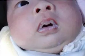 出生3天，宝宝喝了母乳，嘴上长泡被送医，医生：妈妈惹的祸图片