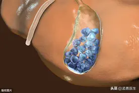胆囊癌的病因及危险因素，早知道早防治图片