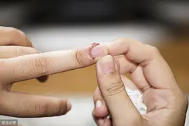 坐诊|指甲顶针凹陷？指甲的损害是判断银屑病的一个重要指标。图片