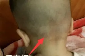 宝宝头上的囟门，为啥有的跳动有的不跳？带你了解“天灵盖儿”图片