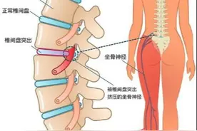 名医专访 | 上海长征医院史国栋：腰椎间盘突出是怎么引起的？图片