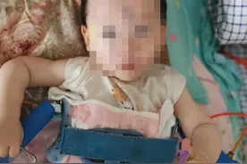 满脸信任，满眼感激！藏族父母千里寻医，保髋矫正终使萌娃康复图片