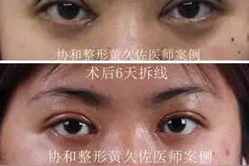 双眼皮（北京协和医院黄久佐）系列案例十五：上睑凹陷矫正图片