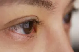 经常戴美瞳有哪些危害？如何科学佩戴？图片