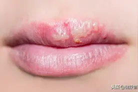 嘴角起泡以为是上火？可能是你免疫力太低，要警惕了图片