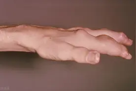 21岁小伙手上长满“石头”，医生：1种甜蜜好喝的水，别再喝了图片