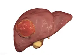 确诊到死亡，胰腺癌只用了一年！3大症状是它的足迹图片