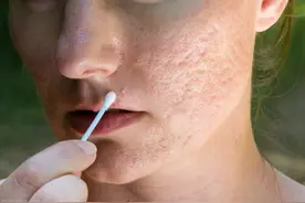 脸上毛孔粗大，像“拔了毛的鸡”怎么办？教你们几个收缩毛孔方法图片