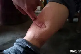 水肿究竟是什么病引起的？肾病、心脏病、肺病还是肝病？图片