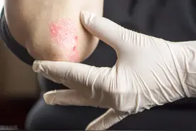 寻常型牛皮癣三联症：鳞屑、薄膜、出血，如何强效对抗银屑病图片
