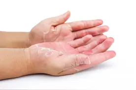 夏天手指上痒到怀疑人生的透明水泡是汗疱疹，医生教你如何远离它图片