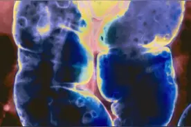 青少年经常肚子疼，嘴唇明显发黑，要注意遗传性息肉病-PJS综合征图片