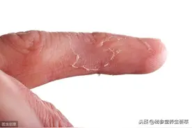 手指脱皮，这些方法可以帮你解决图片