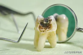 蛀牙坏到什么程度，需要做根管治疗？图片