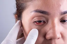 割完眼袋感觉视力模糊怎么办？开眼角越大眼睛越好看吗图片