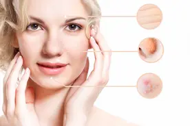 女孩挤痘痘竟造成颅内感染，医生提醒危险三角区的痘痘一定不能挤图片