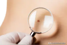 两个部位长了痣，最好定期检查，时间长了癌症可能会悄悄接近你图片