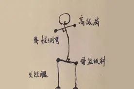长短腿和高低肩，跟骨盆侧倾有什么关系？图片