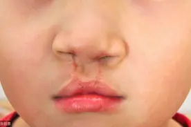 怀孕6个月查出兔唇，导致唇腭裂的5宗罪，做好5件事生出健康宝宝图片