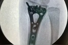 吴京曝谢楠桡骨钢钉照！形状像耙子看着就疼，两人乐观互动显甜蜜图片