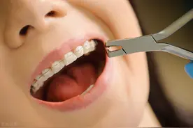 箍好牙，整张脸受益图片