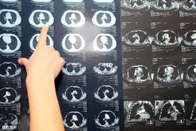 肺部6mm结节有危害吗？成为恶性肿瘤的概率多大？如何处理较好？图片
