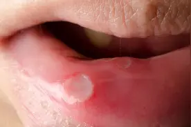 口腔溃疡的日常小妙招！学会了不得口疮快收藏图片