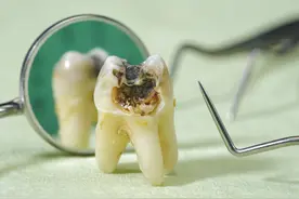 为什么补牙的时候反而要挖个大洞？这样不伤牙吗？听听牙医怎么说图片