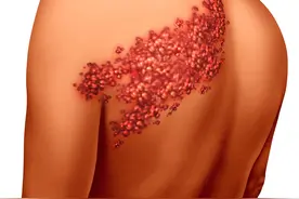 中医上称“缠腰火龙”的带状疱疹也出疫苗了，要打吗？图片