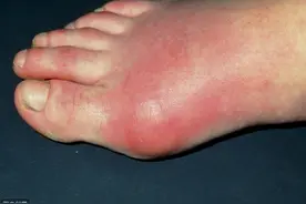 三高都知道，第四高您知道吗？不但引起脚疼，还导致心血管疾病！图片