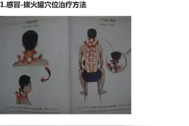 中医拔罐祛病方法大全！（图解治病拔火罐穴位）收了吧图片