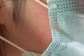 妹子脸上长了脚气，去医院也是一头问号：都是养猫惹出的问题啊图片