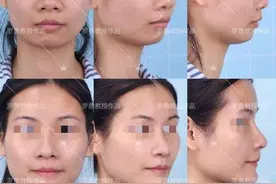 那些隆过鼻的求美者，多年后都变得怎么样了？图片
