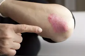 银屑病只是影响美观？错！银屑病还会引起各种并发症，危害健康图片