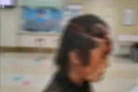 惊险！女子干农活出意外，头发卷进机器里图片