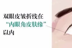 双眼皮眼头眼尾为什么会分叉？双眼皮修复时内外高位疤痕的处理？图片