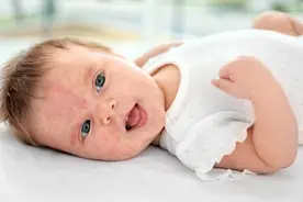 常用于婴幼儿湿疹的五类药物图片