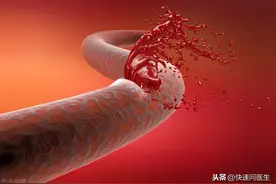 容易发生脑出血的4类人，做到这3点，或能有效预防图片