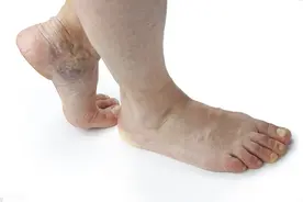 体内有血栓，脚知道！脚上若有4种反应，小心血管随时爆发图片