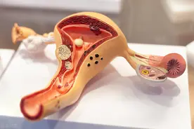 巨大的子宫肌瘤介入栓塞疗效是否受影响？图片