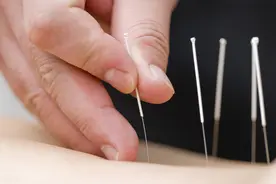 自学针灸成了“小大夫”图片