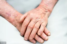 老人手抖不一定是帕金森：甲亢、颈椎病、精神刺激等是常见诱因，需先查明再针对性治疗图片