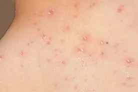 烦！一到夏天，后背痘痘就复发？还有难看痘印？试试这7个小方法图片