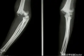 优甲乐的副作用：是否会增加骨质疏松，导致骨折的发生风险？图片