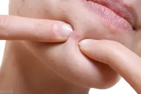 烦人的痘痘，到底要怎样才能摆脱？先找准原因图片