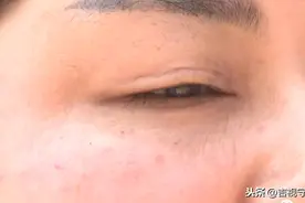 居民楼内做“医美”，注射除皱针后，脸就歪了...图片